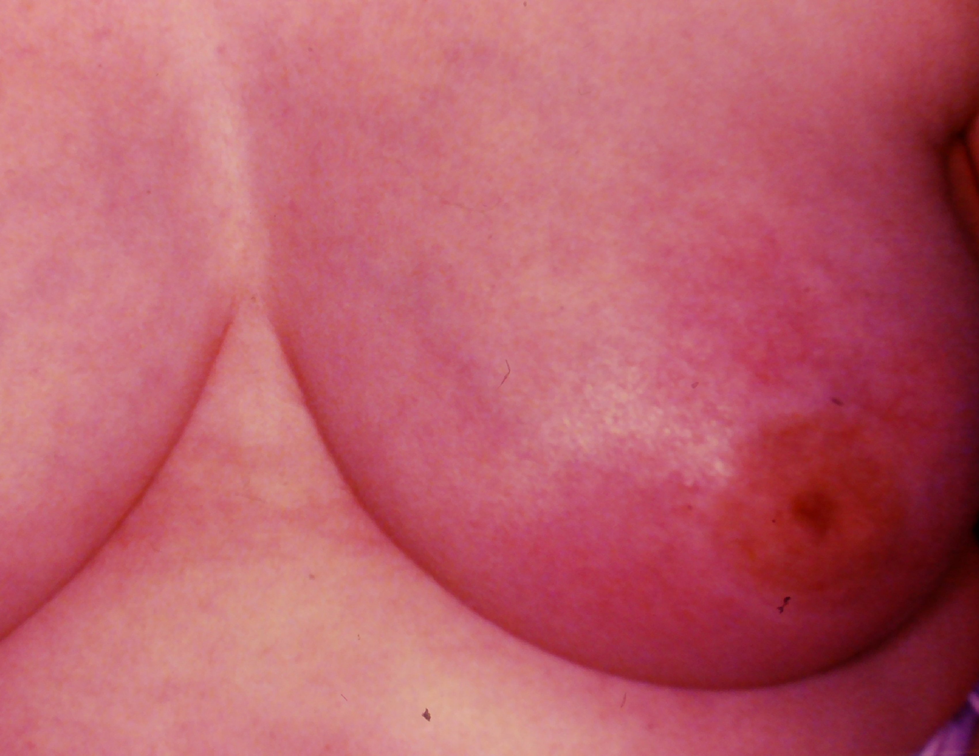 Inflammatory BC