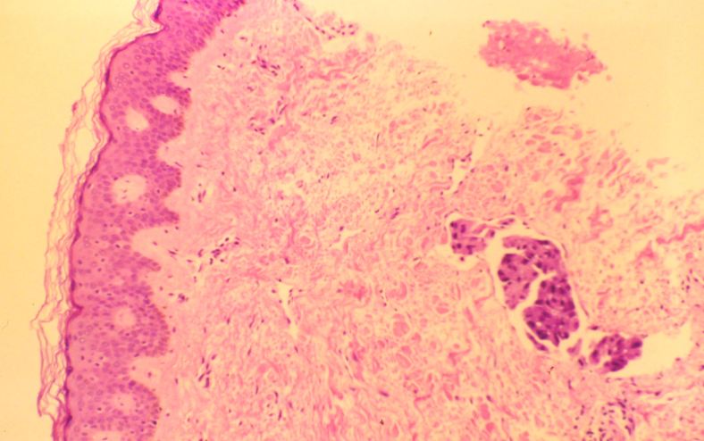 Inflammatory dermal lymphatics involved